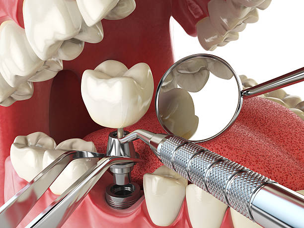Best Emergency Dental Care for Abscessed Tooth in Decatur, MI